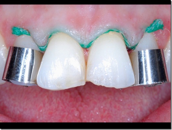 Preparazione per l'installazione delle facette dentali
