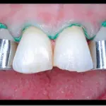 Preparazione per l'installazione delle facette dentali