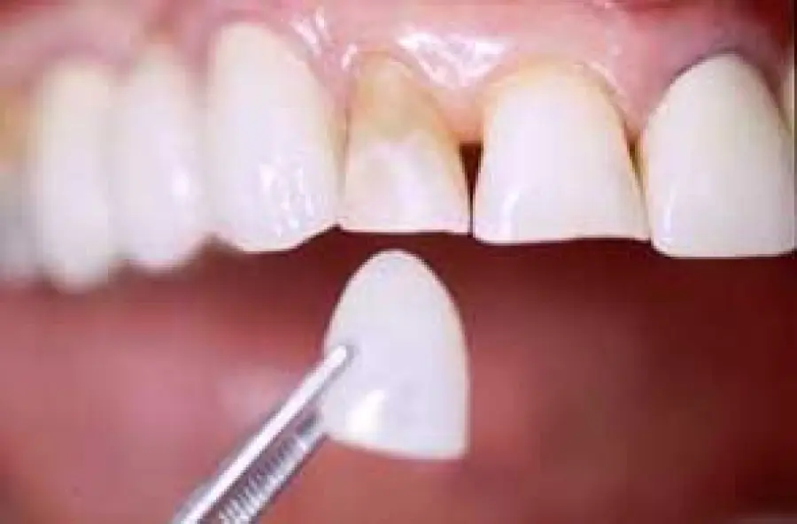 Estetica dentale: faccette per i denti a prezzi accessibili