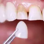 Estetica dentale: faccette per i denti a prezzi accessibili