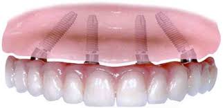 La moderna implantologia dentale